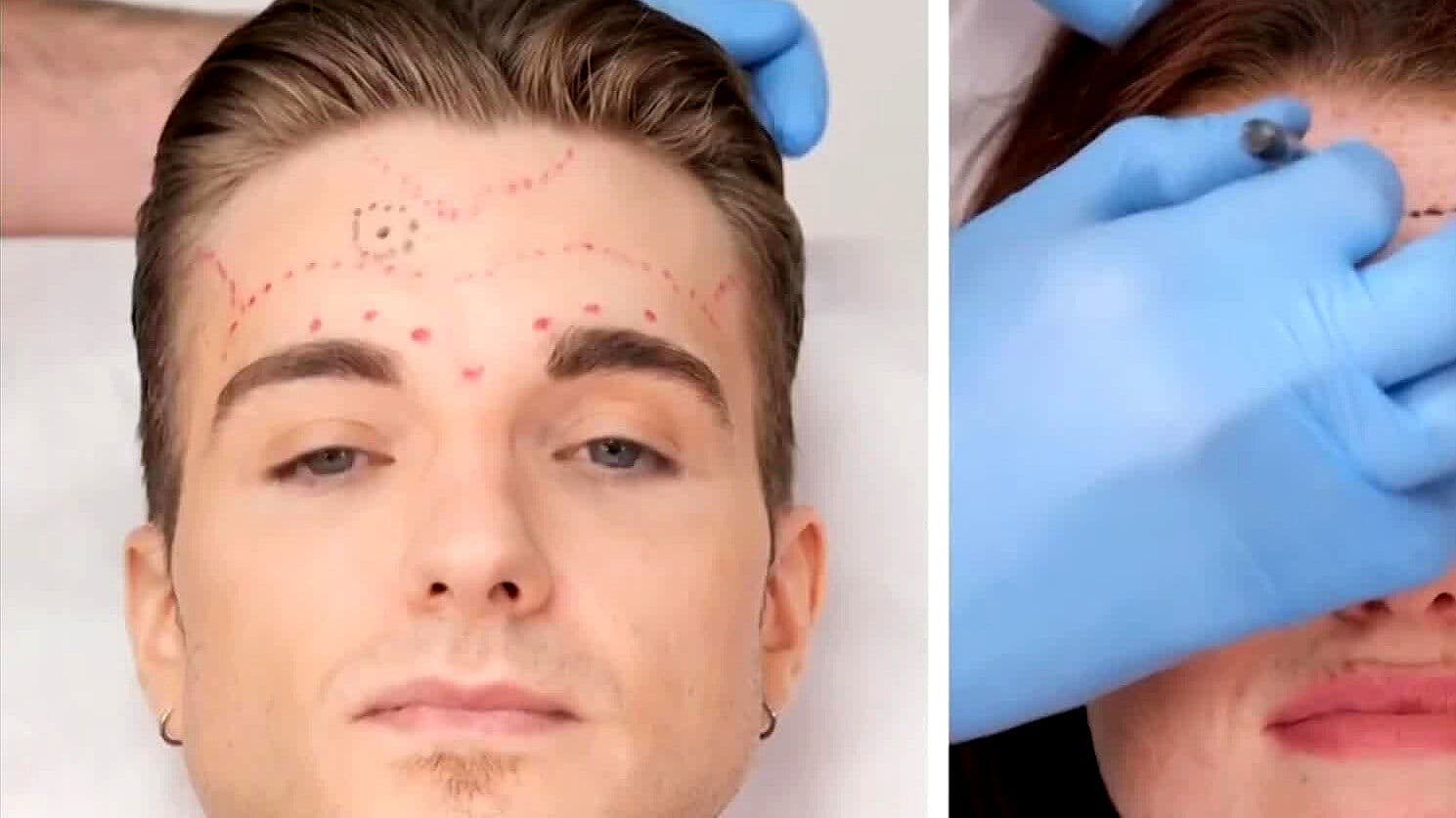 Usos y Beneficios de la Toxina Botulínica